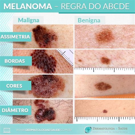 Como Reconhecer Um Melanoma