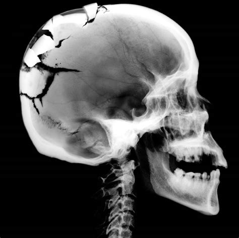 Gallery For > Broken Skull X Ray