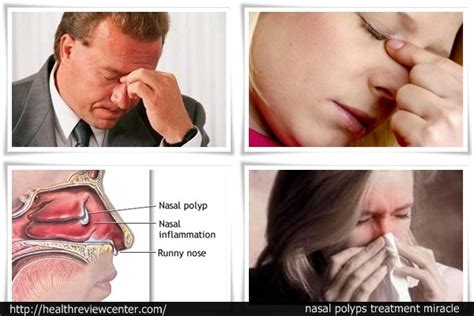 Nasal Polyps How “nasal Polyps Treatment Miracle” Helps People Treat