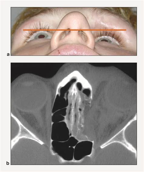 Enophthalmos And Orbital Wall Fracture American Academy Of Ophthalmology