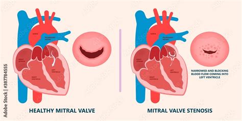 Cath Lab Atrial Septal Defect Tetralogy Of Fallot Patent Foramen Ovale