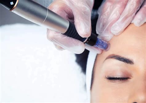 Дермапен для лица - все о процедуре 💗 PROFESSIONALS BEAUTY