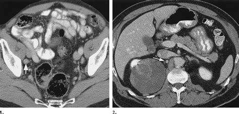 , 2. (1) Benign lymph node in a patient with prostate cancer. Axial ...