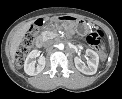 Pancreatic Adenocarcinoma With Extensive Adenopathy Liver Metastases