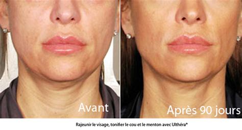 Rajeunir Le Visage Sans Chirurgie Avec Lultherapy Ultherapy Paris