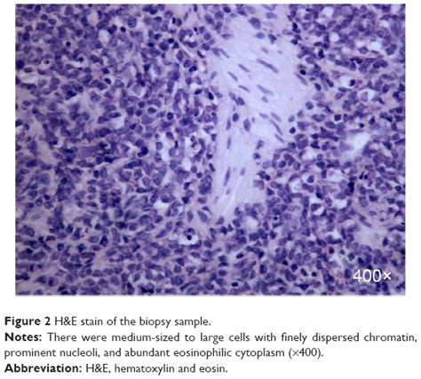 Non Leukemic Myeloid Sarcoma Involving The Vulva Vagina And Cervix Ott