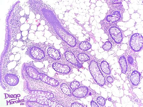 Intramucosal Colonic Lipoma Kiko Xp