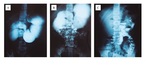 Seriografia O Que É - Aspectos da seriografia gastroduodenal e do trânsito intestinal: (A ...