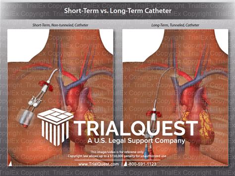 Short Term Vs Long Term Catheter Trial Exhibits Inc