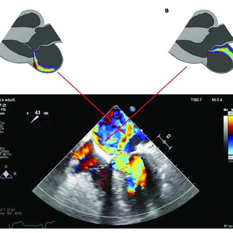 schematic representation  parasternal long axis view showing
