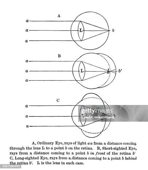 43 Myopia Diagram Stock Photos, High-Res Pictures, and Images - Getty