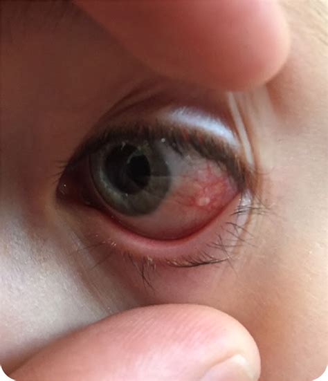 Inclusion Cysts Eyelid