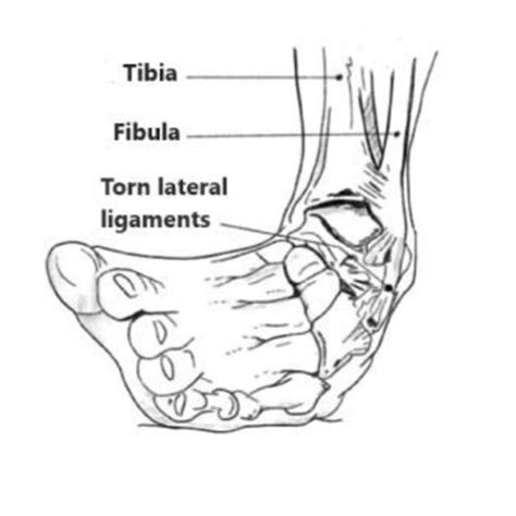 The Most Common Mechanism Of Injury In Lateral Ankle Sprain Is The