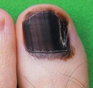 Can Diabetes Cause Toenails To Turn Black Scary Symptoms