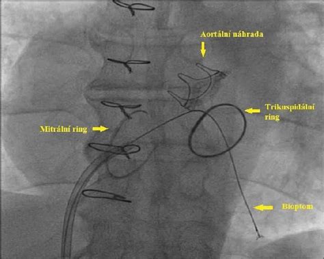 Endomyocardial Biopsy Right Femoral Vein Approach Cook Flexible