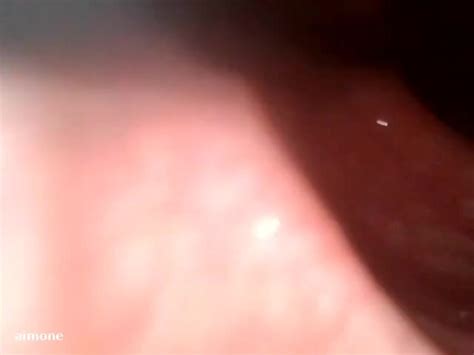 Anal Endoscopic ThisVid