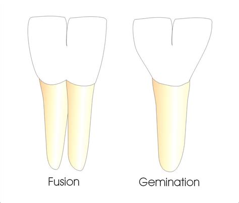 fused teeth