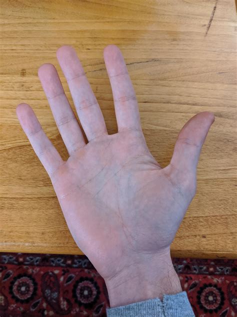 Webbed Fingers Noredtrade