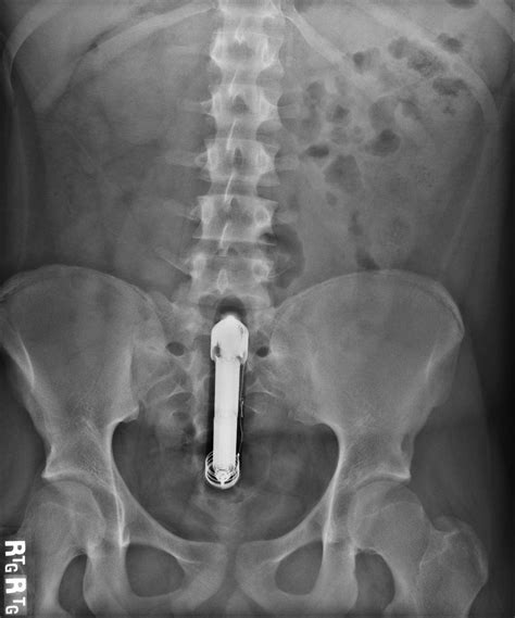 Man Live Tweets Dildo Mishap Complete With X Ray Photo Proof Social News Daily