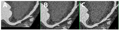 Jcdd Free Full Text Cardiovascular Applications Of Photon Counting