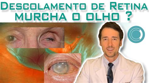 O Descolamento De Retina Pode Murchar O Olho Youtube