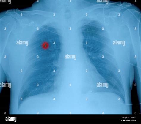 LUNG CANCER, X-RAY Stock Photo - Alamy