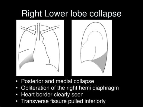 Ppt Lobar Collapse Powerpoint Presentation Free Download Id1163713