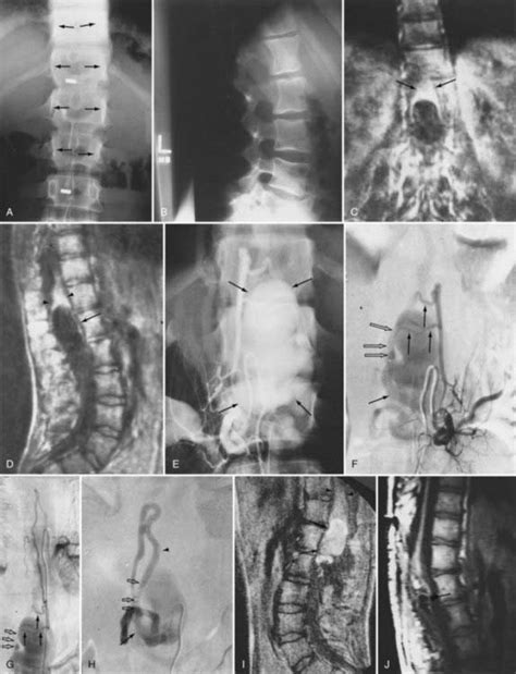 Spinal Vascular Malformations Neupsy Key