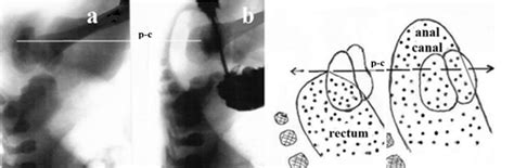 Late Diagnosis Of Congenital Anal Canal Stenosis Case Report And