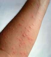 Нейродермит — Медицинский вестник