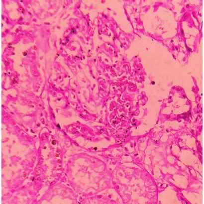 X H E Presence Of Sickled Rbcs In The Liver Sinusoids