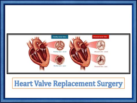 Ppt 5 Common Heart Surgeries You Should Know About Powerpoint