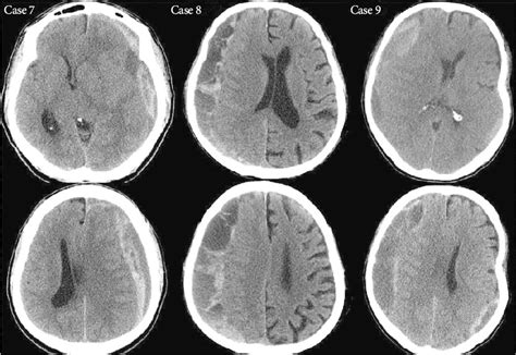 Chronic Subdural Hematoma Vs Acute