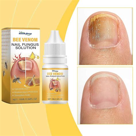 Bee Venom Fungal Nail Treatment for Toenail Extra Strong, Nail Fungus