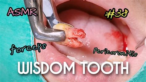 ASMR Wisdom Tooth Extraction In 17 Seconds YouTube