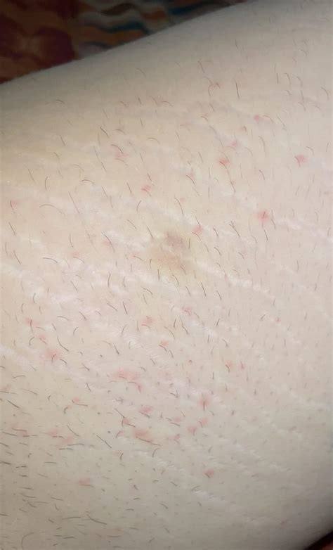 Mollescum??? Or folliculitis : r/molluscum
