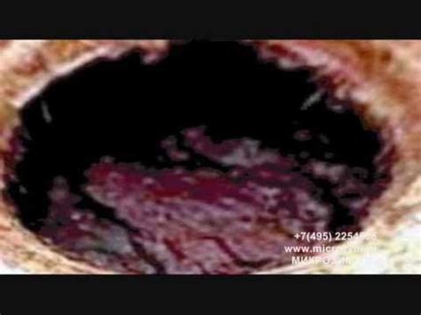 Септик и септические процессы. - YouTube