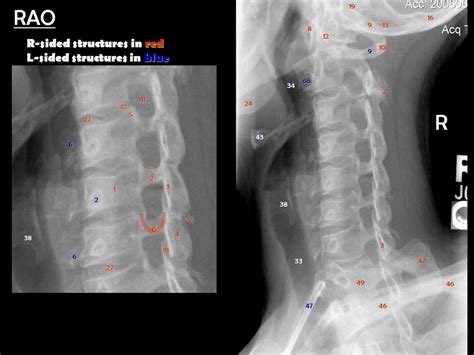 Right Anterior Oblique Diagram Quizlet