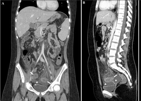 A Abdominal Contrast Enhanced Ct Portal Venous Phase Coronal Image