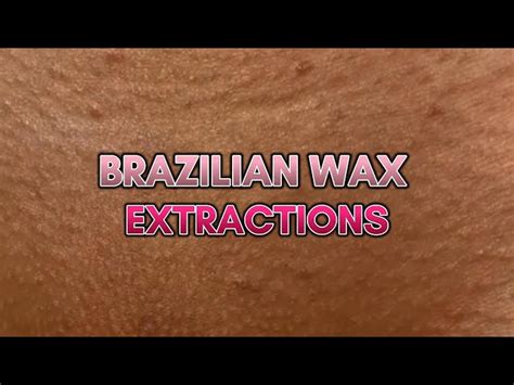 How To Stop Ingrown Hairs After Bikini Wax Sale Online