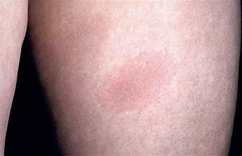 Erythema Migrans Rash Origins Of Health Llc