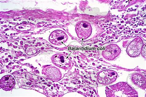 Balantidium Coli Balantidiasis 250x Protozoa Protozoa
