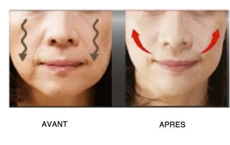 Astuces Pour Rehausser Les Joues Affaiss Es Raffermir La Peau Du