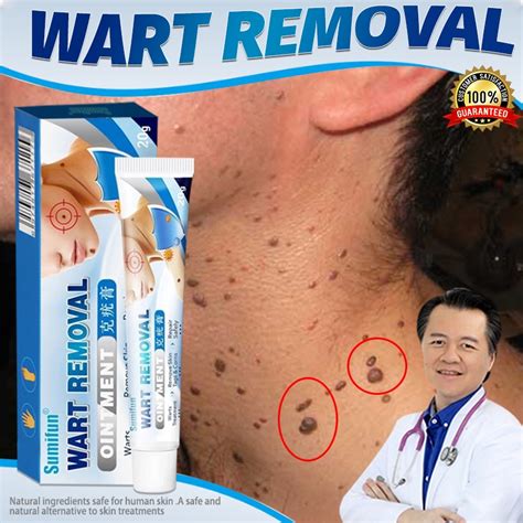 Warts Remover Original Kasoy Oil Cream Mole Skin Tag Wart Remover