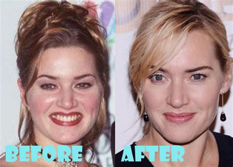 Kate Winslet Plastic Surgery Before and After Photos - Lovely Surgery