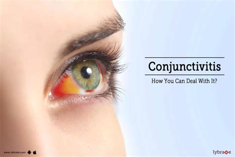 Conjunctivitis How You Can Deal With It By Dr Ravi Thadani Lybrate