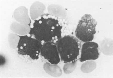 Figure 1 From TdT Positive SmIg Negative B Precursor Cell Leukemia