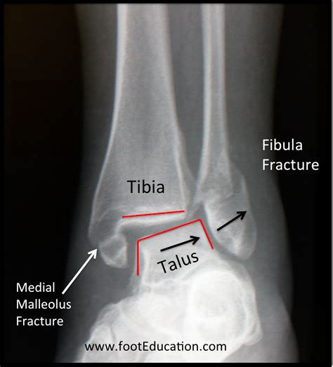 Ankle Fracture - FootEducation