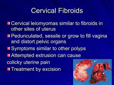 Benign Lesions Of The Cervix Vagina And Vulva Ppt
