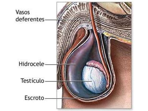 Varicocele Quiste Epididimo Ppt